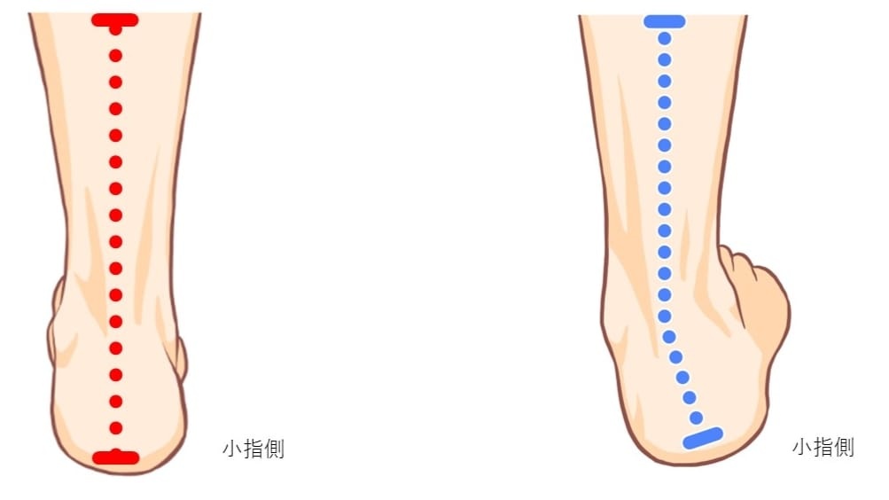 シンスプリントと足首過回内/オーバープロネーショの関係