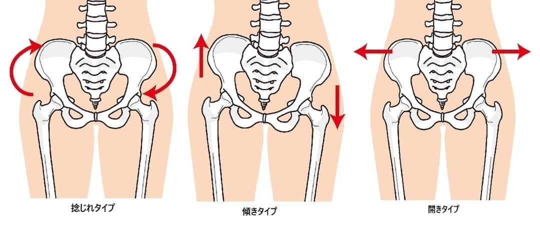 骨盤のゆがみのタイプの画像