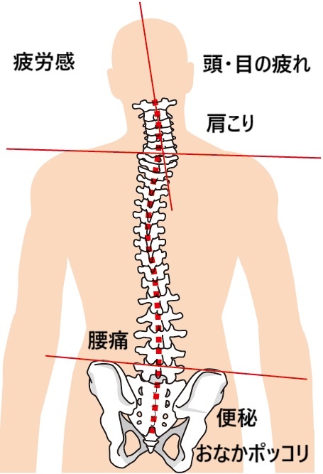 産後の骨盤のゆがみからくる体の不調の図