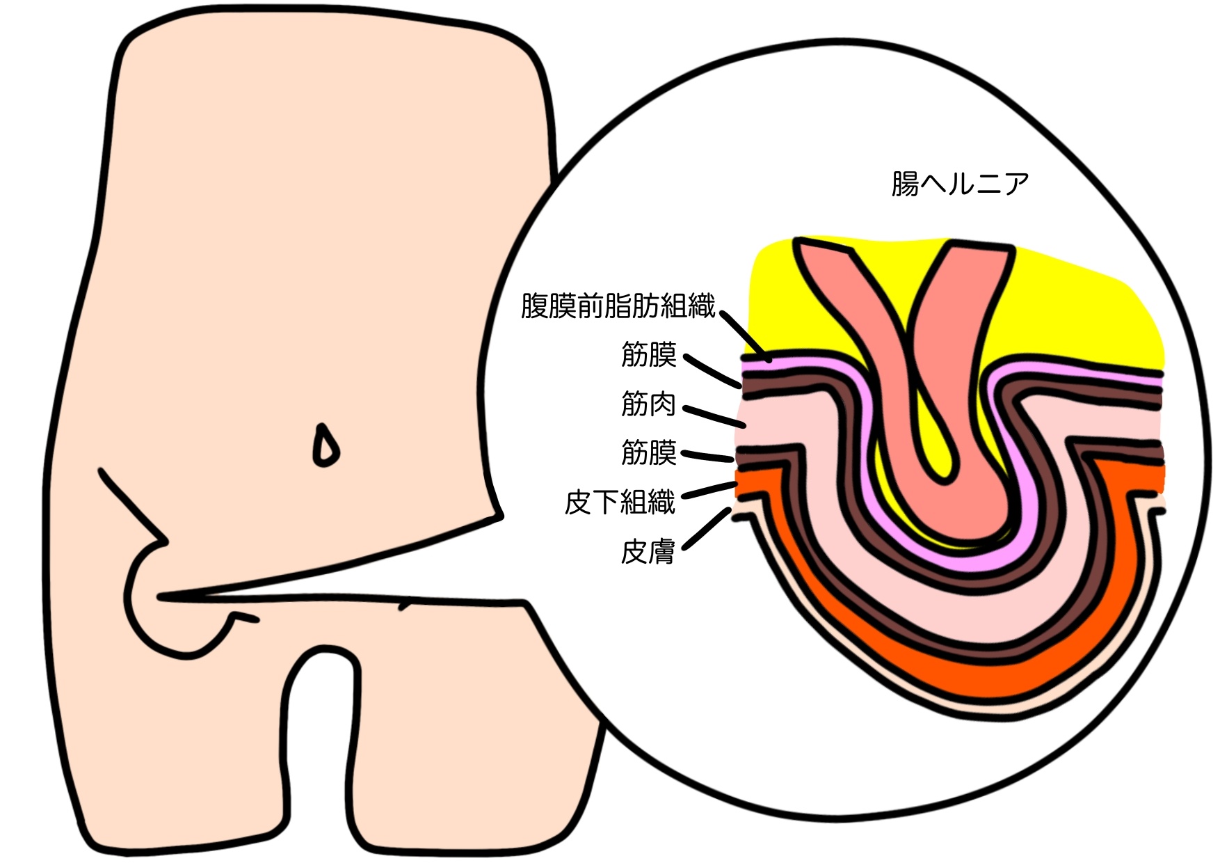 鼠経ヘルニアのイラスト