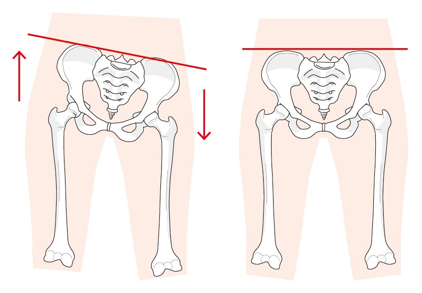 骨盤のゆがみのイラスト
